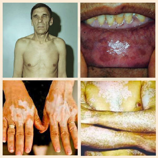 Болезнь Аддисона