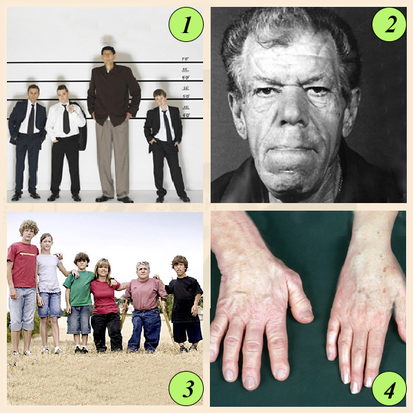 Гигантизм, акромегалия, карликовость – результаты нарушения функции аденогипофиза Результаты нарушения секреции соматотропина