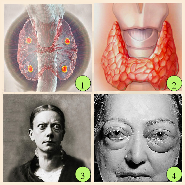Паращитовидная и щитовидная железы. Результаты гипер- и гипофункции щитовидной железы Паращитовидная и щитовидная железы. Дисфункции щитовидной железы