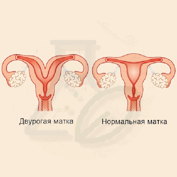 Двурогость матки Двурогость матки