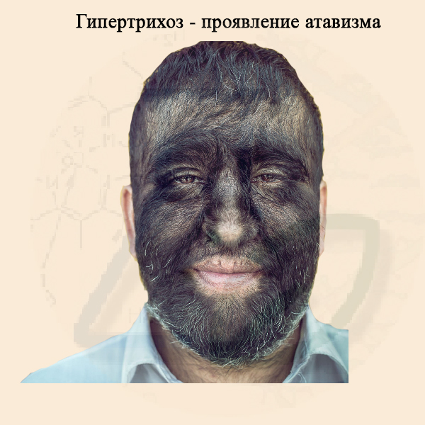 Гипертрихоз – излишнее оволосение частей тела Гипертрихоз - атавизм