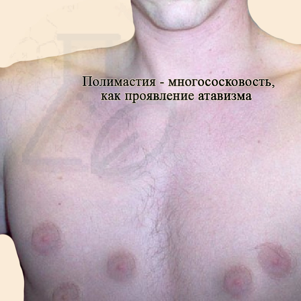 Полимастия – многососковость, как проявление атавизма Полимастия - атавизм