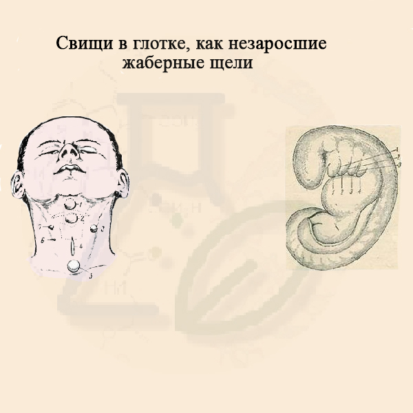 Свищи в глотке - результат незаросших жаберных щелей Свищи в глотке