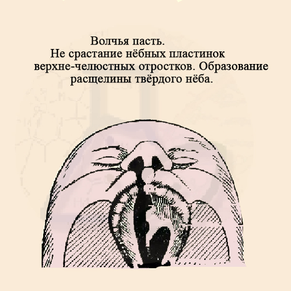 Волчья пасть – результат увеличения числа хромосом Волчья пасть
