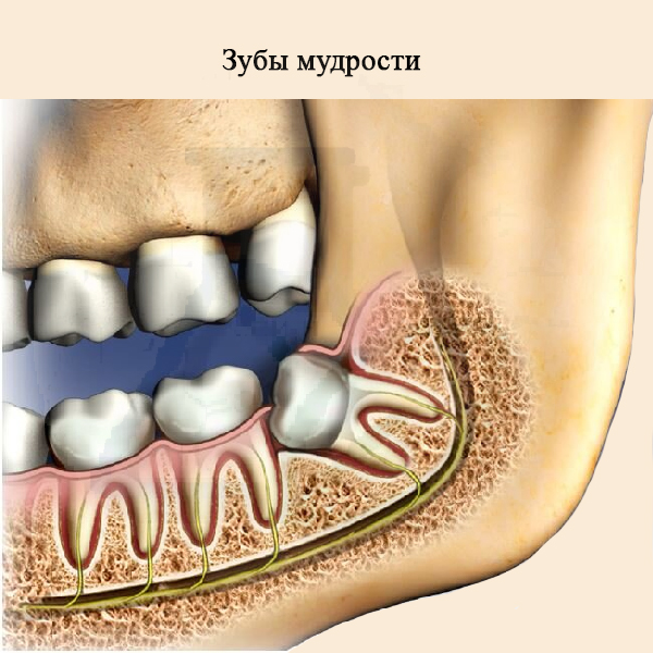 Зубы мудрости Зубы мудрости